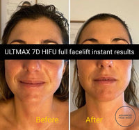 MAY SPECIAL - 'ULTMAX' 7D HIFU FACE EYES & NECK LIFT - THE ESSENTIAL NON SURGICAL FACELIFT