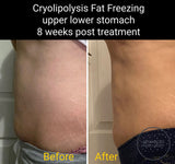 MAY SPECIAL - CRYOLIPOLYSIS FAT FREEZING TREATMENT - PERMANENTLY REMOVE YOUR STUBBORN FAT