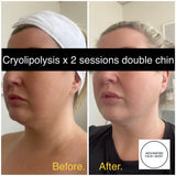 MAY SPECIAL - DOUBLE CHIN CRYOLIPOLYSIS FAT FREEZING TREATMENT - TIGHTEN, LIFT & CONTOUR YOUR CHIN & JAWLINE