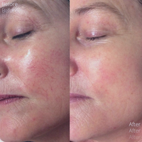 MAY SPECIAL - LASER RED VEIN REMOVAL TREATMENT