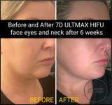 7D HIFU lower face and Neck Rejuvenation treatment