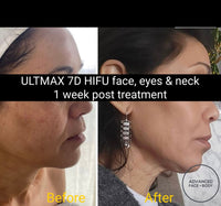 'ULTMAX' HIFU FACELIFT TREATMENT - THE ESSENTIAL NON SURGICAL FACELIFT