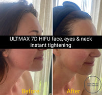 MAY SPECIAL - 'ULTMAX' 7D HIFU FACE EYES & NECK LIFT - THE ESSENTIAL NON SURGICAL FACELIFT