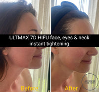 'ULTMAX' HIFU FACELIFT TREATMENT - THE ESSENTIAL NON SURGICAL FACELIFT