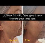 SEP 23 - 7D ULTMAX HIFU FACE LIFTING AND REJUVENATION - FACE, EYES AND NECK - ONLY $799 OR 2 FOR $999 (USUALLY $3,499 EACH)