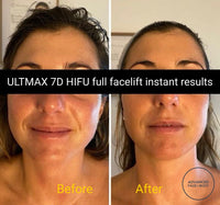 'ULTMAX' HIFU FACELIFT TREATMENT - THE ESSENTIAL NON SURGICAL FACELIFT