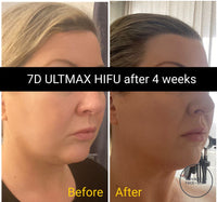 'ULTMAX' HIFU FACELIFT TREATMENT - THE ESSENTIAL NON SURGICAL FACELIFT