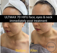 MAY SPECIAL - 'ULTMAX' 7D HIFU FACE EYES & NECK LIFT - THE ESSENTIAL NON SURGICAL FACELIFT