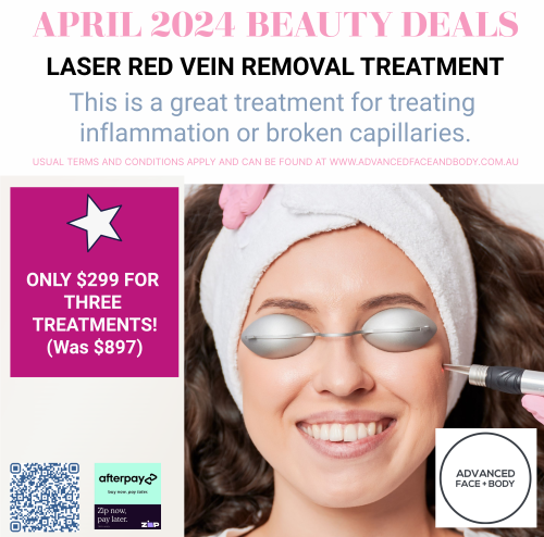 APRIL 24 - LASER RED VEIN REMOVAL TREATMENT THREE FOR $299 (WAS $897)