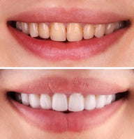 OFFER FIRST TIME CLIENT - TEETH WHITENING TREATMENT - Whiten Your Teeth By Up To 5 Shades Only $79 (normally $300)