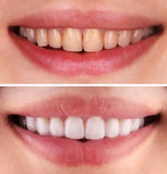 OFFER FIRST TIME CLIENT - TEETH WHITENING TREATMENT - Whiten Your Teeth By Up To 5 Shades Only $79 (normally $300)