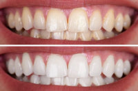 OFFER FIRST TIME CLIENT - TEETH WHITENING TREATMENT - Whiten Your Teeth By Up To 5 Shades Only $79 (normally $300)