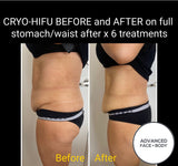 MAY SPECIAL - 8D HIFU BODY SLIM TREATMENT SALE - PERMANENTLY MELT FAT & TIGHTEN SKIN