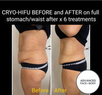OFFER - LIMITED TIME FOR FIRST TIME CLIENTS ONLY - 8D CRYO-HIFU FACE OR BODY TREATMENT - Up to 89% Off
