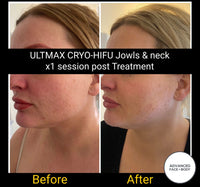SEP 23 - 'CRYO-HIFU' 7D NECK AND JOWL SLIMMING - ONLY $399 OR 3 FOR $599 (USUALLY $1,799 EACH)