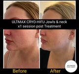 MAR 25 - THE ULTIMATE NECK & JOWL PACKAGE - RF TIGHTENING WITH 8D CRYO-HIFU includes FREE Take Home LED/EMS DEVICE