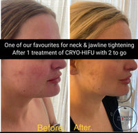 MAR 25 - THE ULTIMATE NECK & JOWL PACKAGE - RF TIGHTENING WITH 8D CRYO-HIFU includes FREE Take Home LED/EMS DEVICE