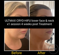 MAR 25 - THE ULTIMATE NECK & JOWL PACKAGE - RF TIGHTENING WITH 8D CRYO-HIFU includes FREE Take Home LED/EMS DEVICE