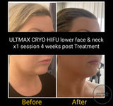 MAR 25 - THE ULTIMATE NECK & JOWL PACKAGE - RF TIGHTENING WITH 8D CRYO-HIFU includes FREE Take Home LED/EMS DEVICE
