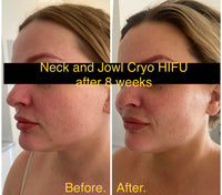 7D HIFU lower face and Neck Rejuvenation treatment