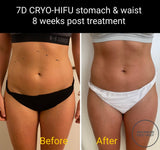SEP 23 - CRYO-HIFU 7D ULTMAX BODY SLIMMING - ONLY $499 OR 3 FOR $599 (USUALLY $1999 EACH)