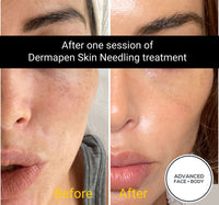 SEP 23 - DERMAPEN SKIN NEEDLING FACE TREATMENT - SKIN PERFECTING - ONLY $199 OR 3 FOR $349 (USUALLY $350 EACH)
