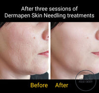 SEP 23 - DERMAPEN SKIN NEEDLING FACE TREATMENT - SKIN PERFECTING - ONLY $199 OR 3 FOR $349 (USUALLY $350 EACH)
