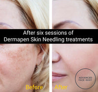 MAY SPECIAL - DERMAPEN SKIN NEEDLING SALE Choose from One or Three Treatments