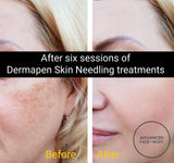 SEP 23 - DERMAPEN SKIN NEEDLING FACE TREATMENT - SKIN PERFECTING - ONLY $199 OR 3 FOR $349 (USUALLY $350 EACH)