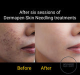 MAY SPECIAL - DERMAPEN SKIN NEEDLING SALE Choose from One or Three Treatments