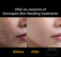SEP 23 - DERMAPEN SKIN NEEDLING FACE TREATMENT - SKIN PERFECTING - ONLY $199 OR 3 FOR $349 (USUALLY $350 EACH)