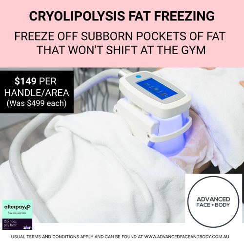 FEB 25 - CRYOLIPOLYSIS FAT FREEZING TREATMENT SALE - Permanently remove stubborn fat pockets