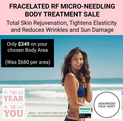 FEB 25 - FRACELATED RF MICRO-NEEDLING TREATMENT (Treat wrinkles, loose skin, acne, scars, stretch marks & enlarged pores)