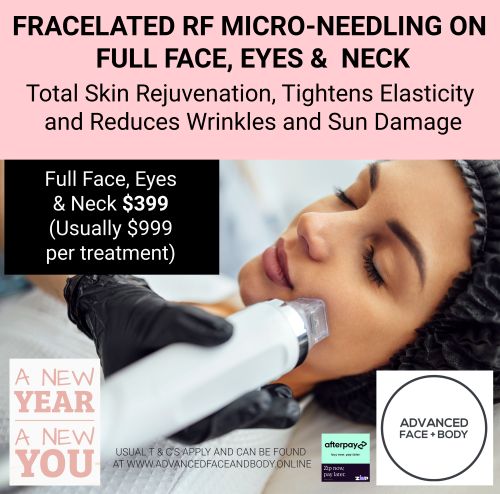 FEB 25 - FRACELATED RF MICRO-NEEDLING FACE TREATMENT (Treat wrinkles, loose skin, acne, scars, stretch marks & enlarged pores)