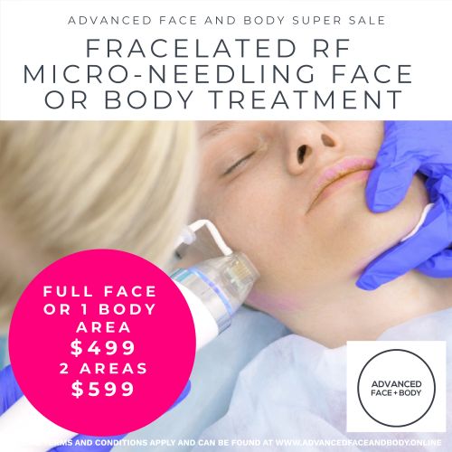 Oct 25 - Fracelated RF Micro-Needling Treatment (Treat wrinkles, acne, scars, pores, stretch marks & tighten loose skin)