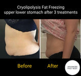 MAY SPECIAL - CRYOLIPOLYSIS FAT FREEZING TREATMENT - PERMANENTLY REMOVE YOUR STUBBORN FAT