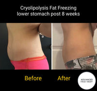 MAY SPECIAL - CRYOLIPOLYSIS FAT FREEZING TREATMENT - PERMANENTLY REMOVE YOUR STUBBORN FAT