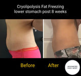 MAY SPECIAL - CRYOLIPOLYSIS FAT FREEZING TREATMENT - PERMANENTLY REMOVE YOUR STUBBORN FAT