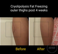 SEP 23 - CRYOLIPOLYSIS FAT FREEZING - REMOVE STUBBORN FAT - ONLY $149 OR 3 FOR $299 (USUALLY $499 EACH)