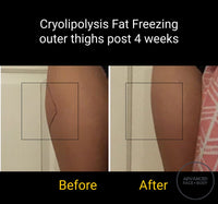 MAY SPECIAL - CRYOLIPOLYSIS FAT FREEZING TREATMENT - PERMANENTLY REMOVE YOUR STUBBORN FAT