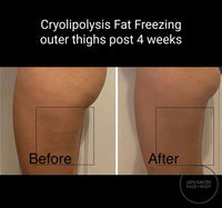 MAY SPECIAL - CRYOLIPOLYSIS FAT FREEZING TREATMENT - PERMANENTLY REMOVE YOUR STUBBORN FAT