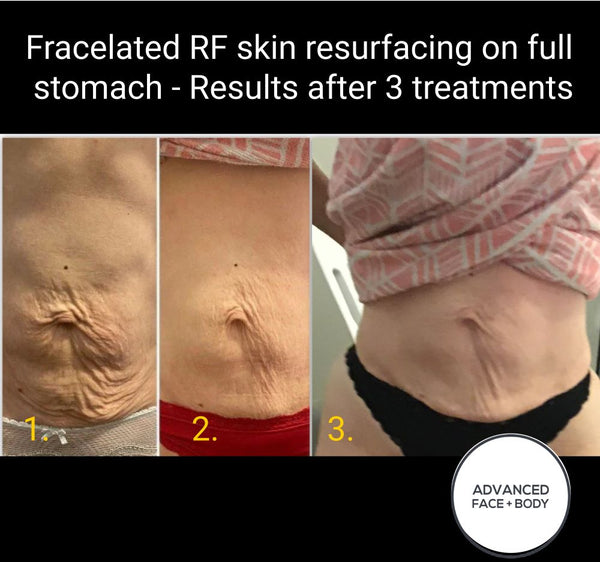 MAR 24 - FRACELATED RF MICRO-NEEDLING - SKIN TIGHTENING & REJUVENATION TREATMENT SALE