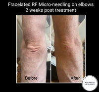 MAY SPECIAL - FRACELATED RF MICRO-NEEDLING - TOTAL SKIN REJUVINATION TREATMENT FOR FACE OR BODY