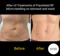 SEP 23 - FRACELATED RF MICRONEEDLING FACE OR BODY SKIN TREATMENT - ONLY $499 OR 3 FOR $599 (USUALLY $680 EACH)