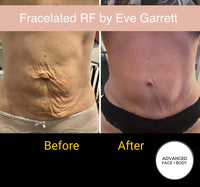 MAY SPECIAL - FRACELATED RF MICRO-NEEDLING - TOTAL SKIN REJUVINATION TREATMENT FOR FACE OR BODY