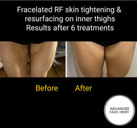 MAY SPECIAL - FRACELATED RF MICRO-NEEDLING - TOTAL SKIN REJUVINATION TREATMENT FOR FACE OR BODY