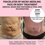 MAR 25 - FRACELATED RF MICRO-NEEDLING TREATMENT (Treat wrinkles, loose skin, acne, scars, stretch marks & enlarged pores)