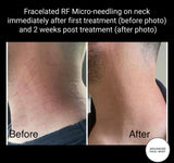 SEP 23 - FRACELATED RF MICRONEEDLING FACE OR BODY SKIN TREATMENT - ONLY $499 OR 3 FOR $599 (USUALLY $680 EACH)