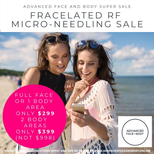 FRACELATED RF MICRO-NEEDLING TREATMENT SALE (Treat wrinkles, loose skin, acne, scars, stretch marks & enlarged pores)