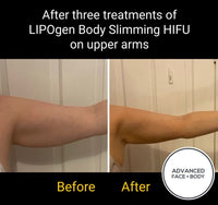SEP 23 -  LIPOgen HIFU Body Sculpting ONLY $299 or 3 for $599 (Was $998.00 EACH)